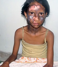 A 12-year-old burned in riots