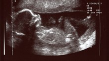 How a Pro-Life Bill Could Lead to More Abortions How a Pro-Life Bill Could Lead to More Abortions
