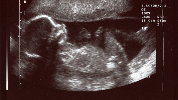 How a Pro-Life Bill Could Lead to More Abortions